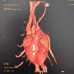 PRAA in cats - 3D Volume Rendering CT Angiography - A Surgical Roadmap